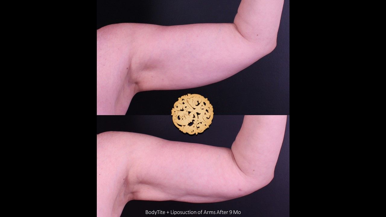 Liposuction Arms Before & After