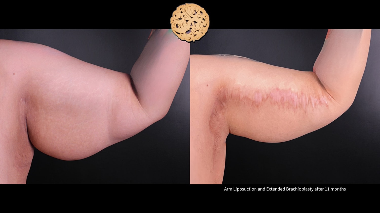 Liposuction Arms Before & After
