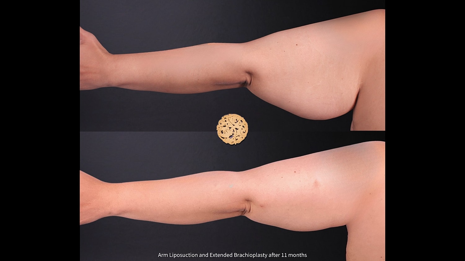 Liposuction Arms Before & After