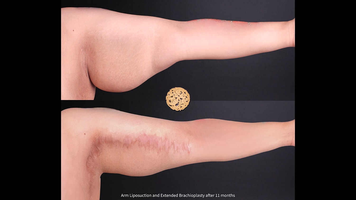 Liposuction Arms Before & After