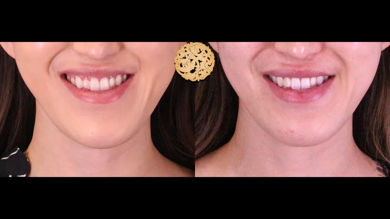 Xeomin Before & After