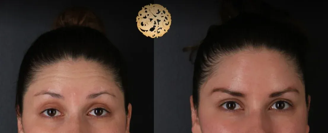 Xeomin Before & After