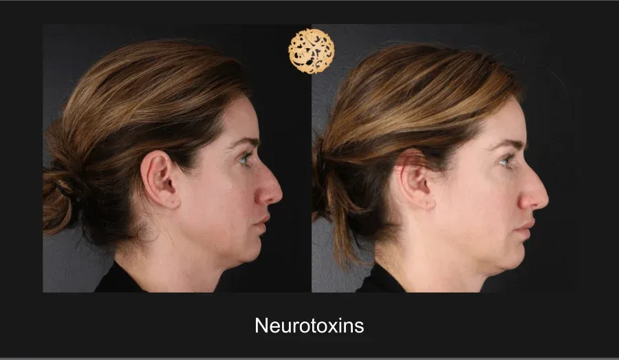 Xeomin Before & After