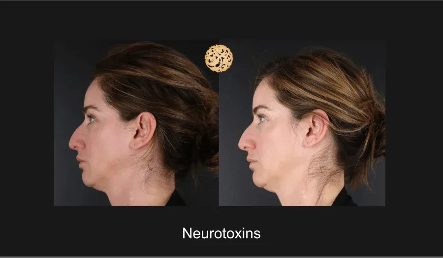 Xeomin Before & After