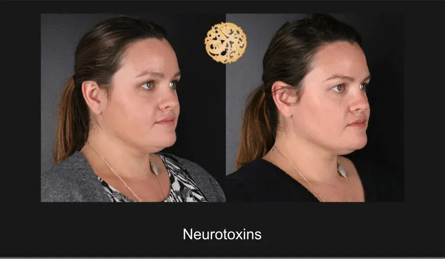 Xeomin Before & After