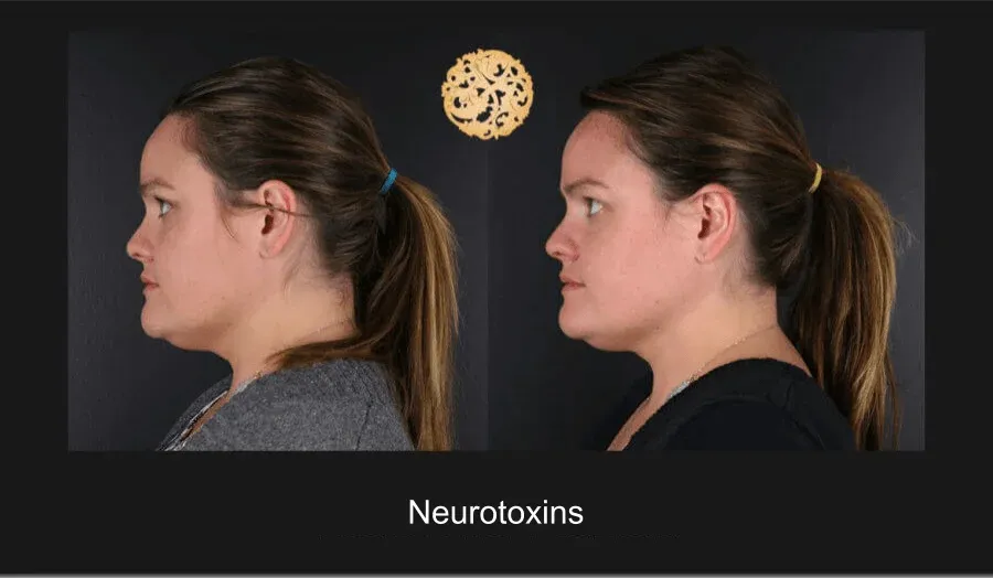 Xeomin Before & After