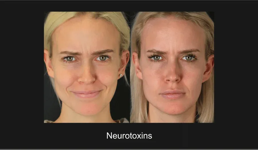 Xeomin Before & After
