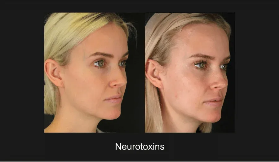 Xeomin Before & After