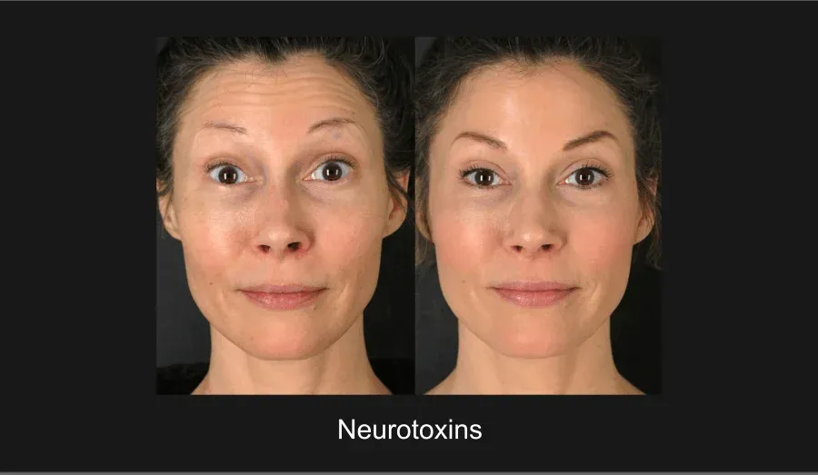 Xeomin Before & After