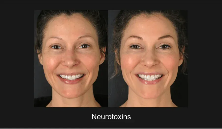 Xeomin Before & After