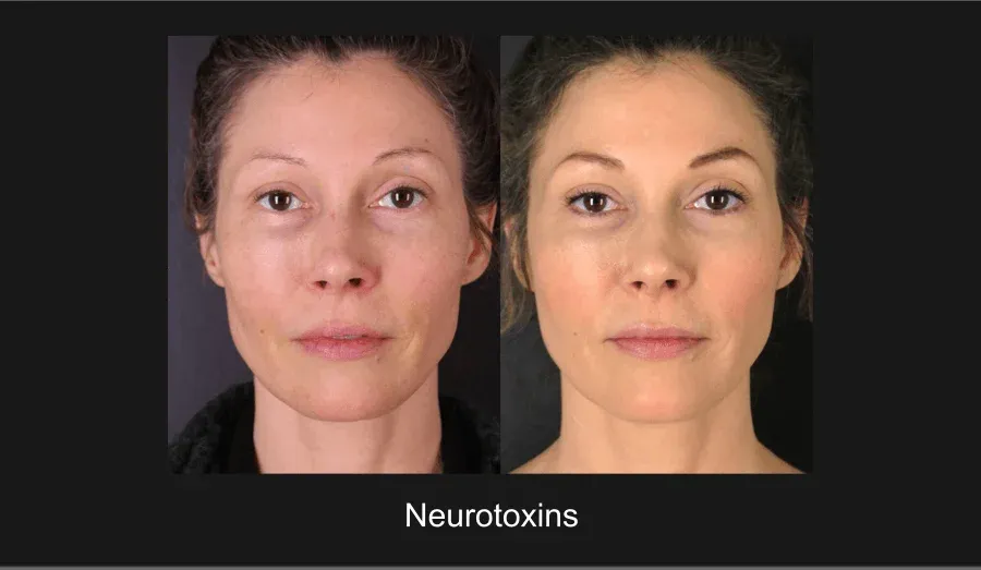Xeomin Before & After