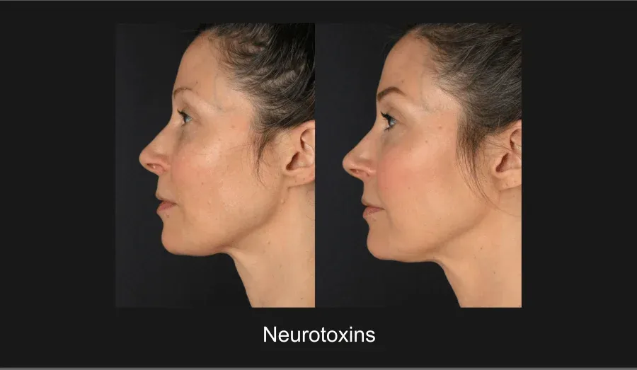 Xeomin Before & After