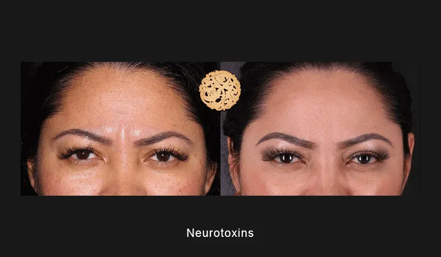 Xeomin Before & After