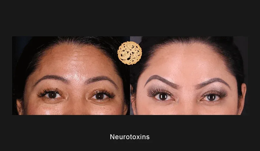 Xeomin Before & After
