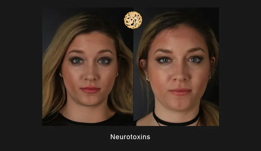 Xeomin Before & After