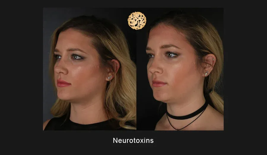 Xeomin Before & After