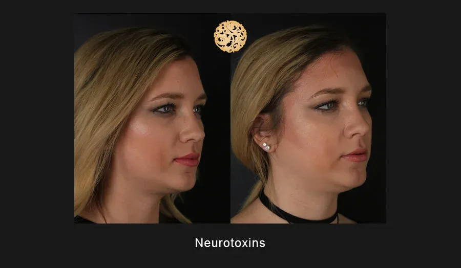 Xeomin Before & After