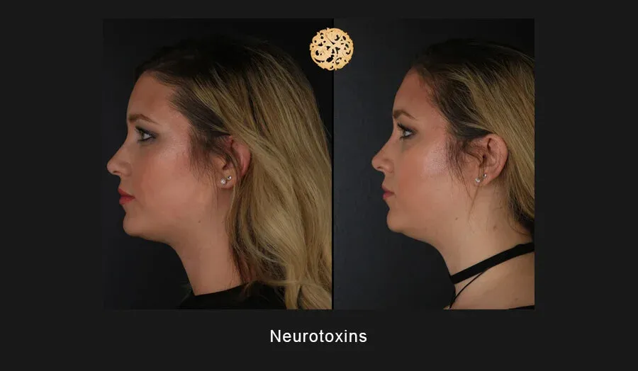 Xeomin Before & After