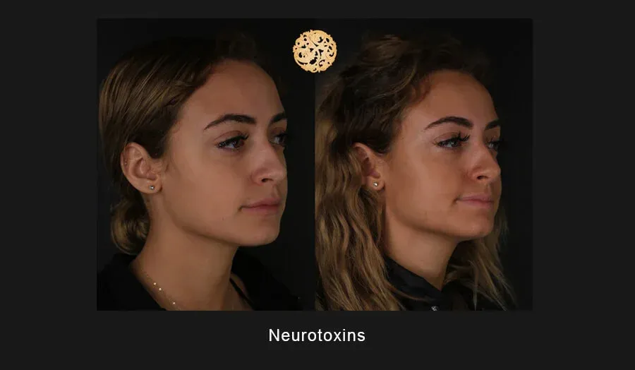 Xeomin Before & After