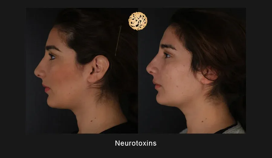Xeomin Before & After