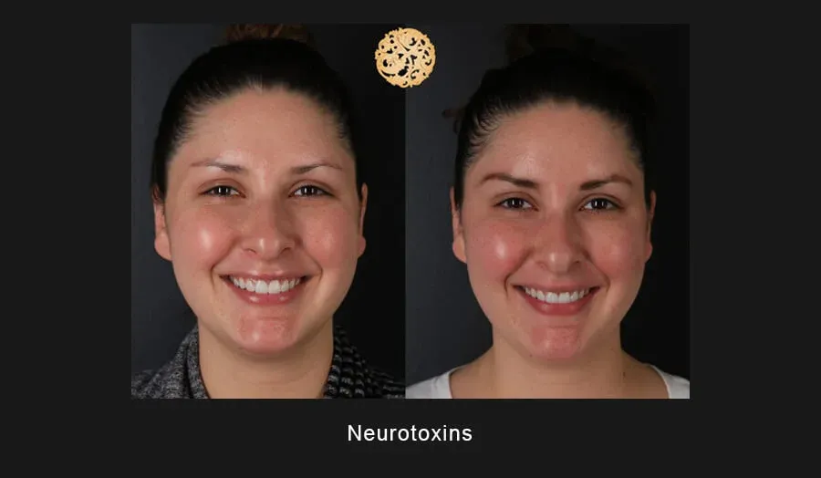 Xeomin Before & After