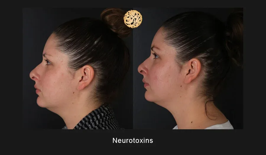 Xeomin Before & After