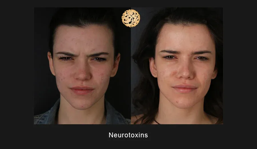 Xeomin Before & After