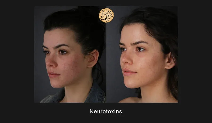 Xeomin Before & After