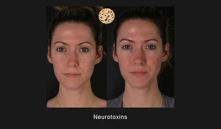 Xeomin Before & After