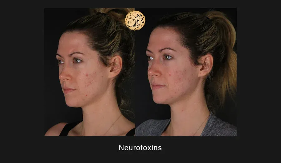 Xeomin Before & After