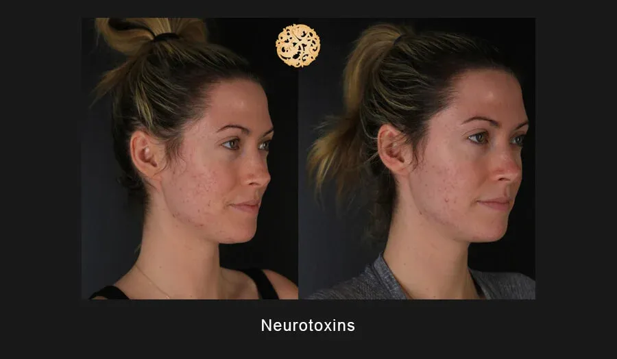 Xeomin Before & After