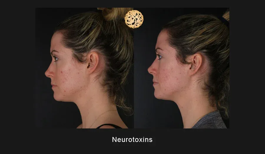Xeomin Before & After
