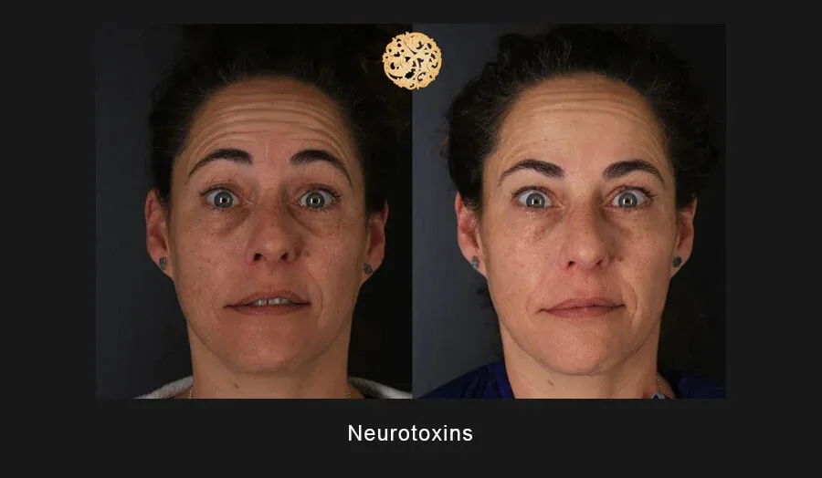 Xeomin Before & After