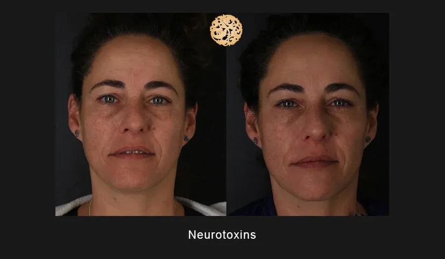 Xeomin Before & After