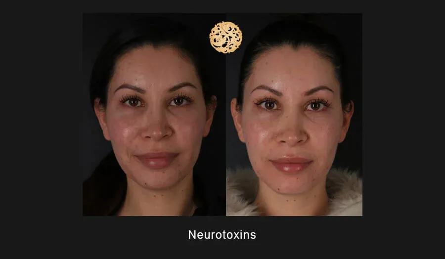 Xeomin Before & After