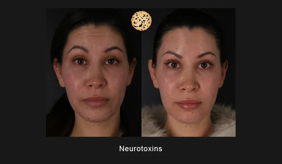 Xeomin Before & After