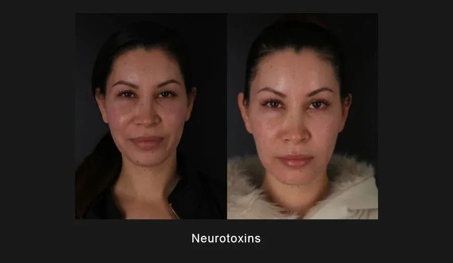 Xeomin Before & After