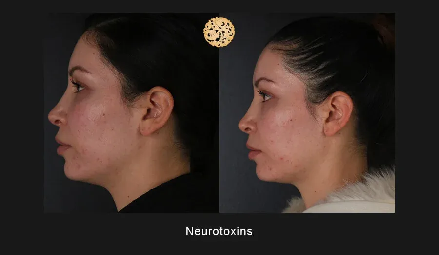 Xeomin Before & After