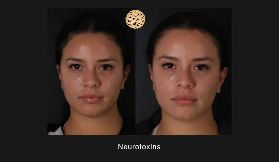 Xeomin Before & After