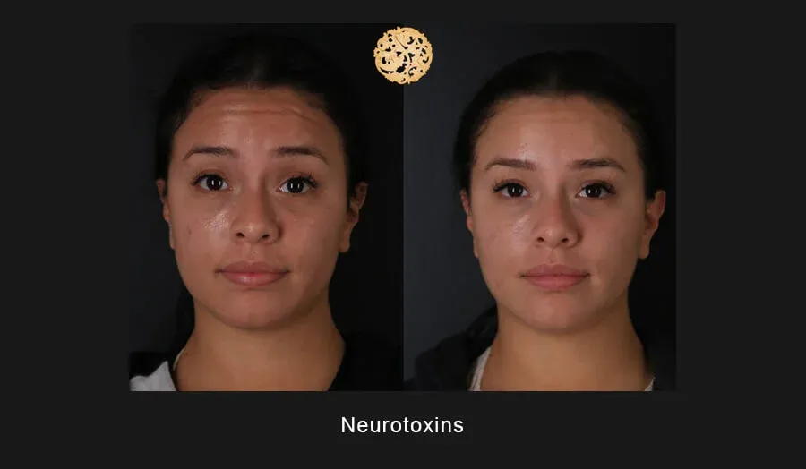 Xeomin Before & After