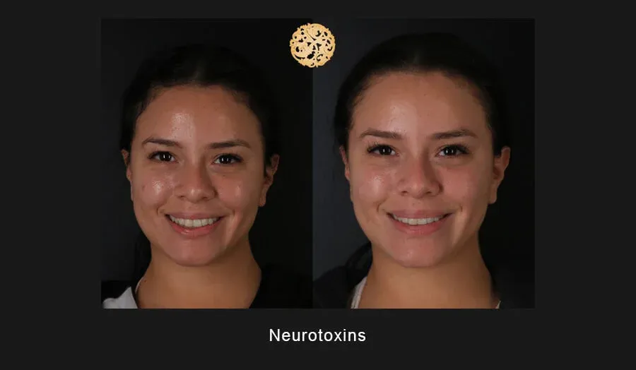 Xeomin Before & After