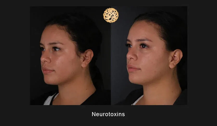 Xeomin Before & After