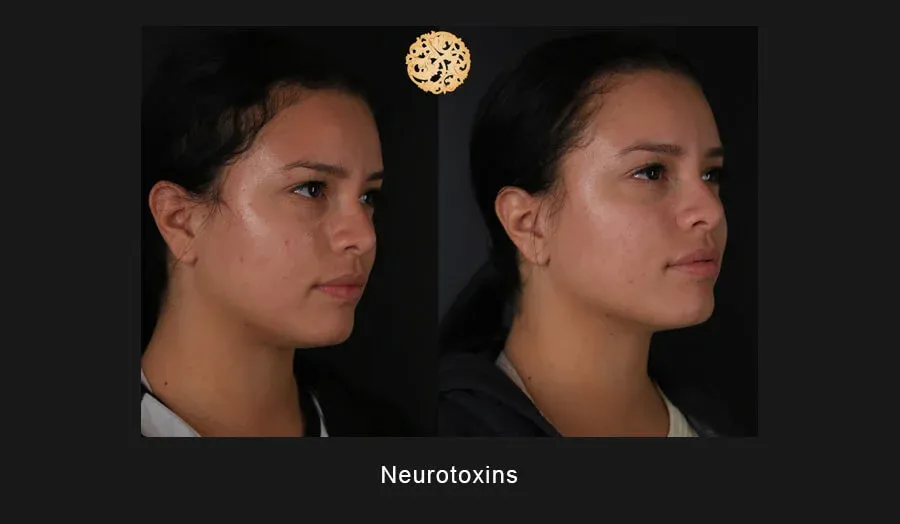 Xeomin Before & After