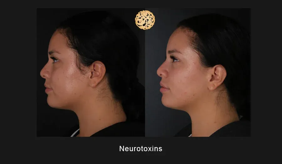 Xeomin Before & After