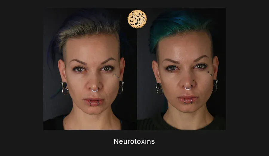 Xeomin Before & After