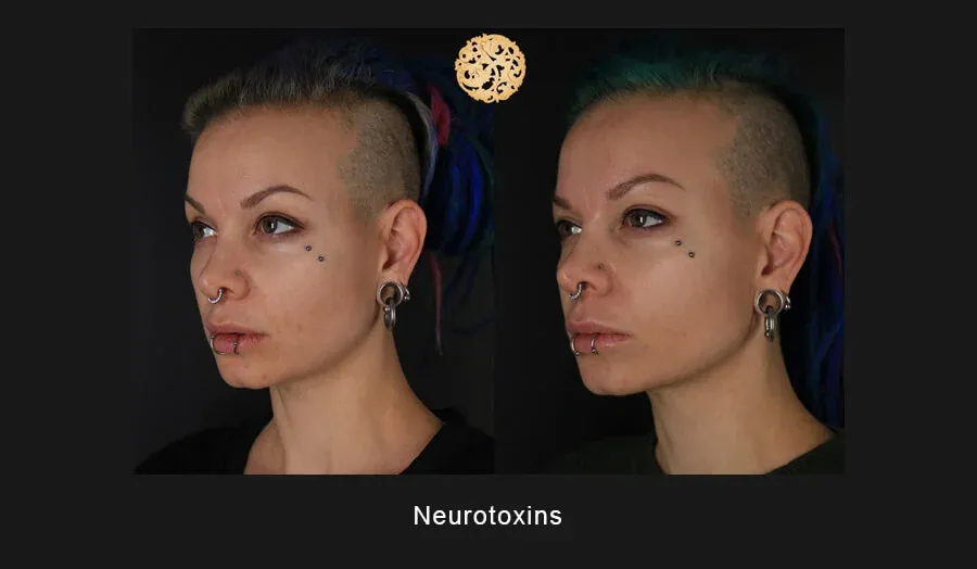 Xeomin Before & After