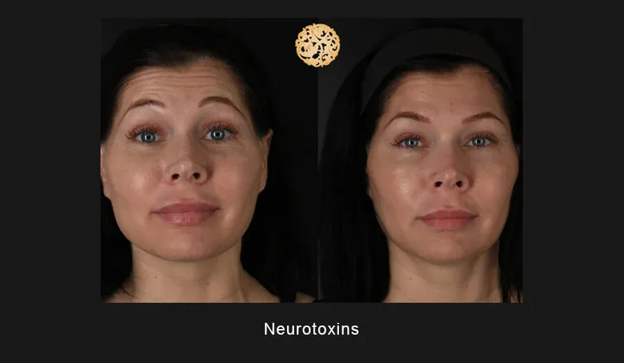 Xeomin Before & After