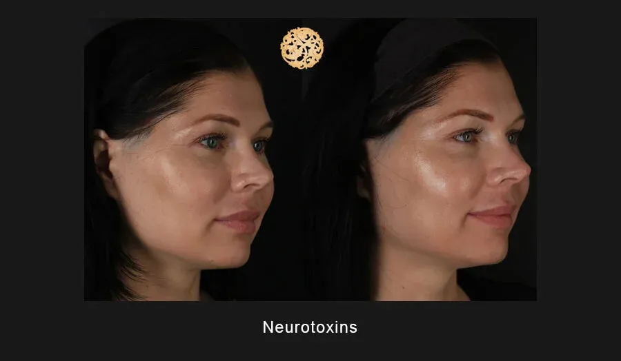 Xeomin Before & After