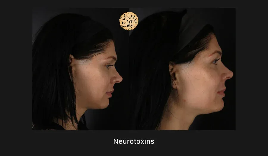 Xeomin Before & After