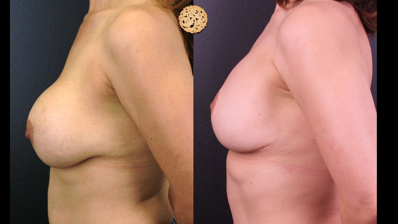 Breast Implant Exchange Before & After